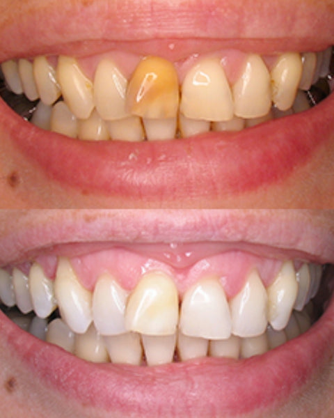 Customer before and after results. Whiter, brighter teeth from WhiteWaveSmile's bestselling world leading home dental products. 