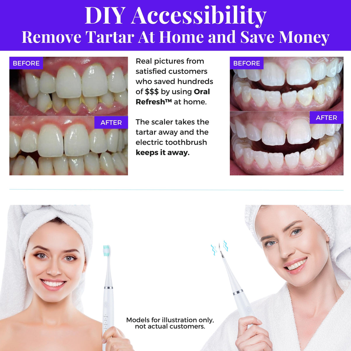 Best electric dental scaler before and after pictures customer results. Save money with Oral Refresh from WhiteWaveSmile.