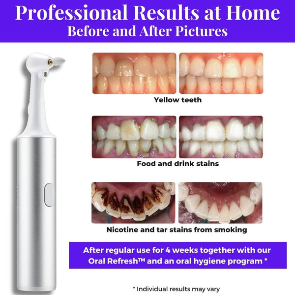 Best electric tooth polisher before and after positive customer results. Removes food, drink, nicotine, tar, smoke stains. PermaWhite superior home electric tooth polisher from WhiteWaveSmile
